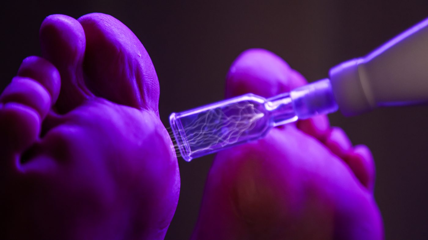Głowica Hyper Plasma z widocznymi wyładowaniami zimnej plazmy przy skórze stopy