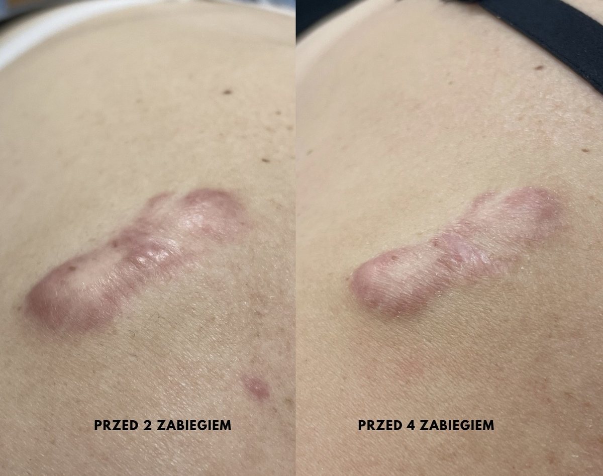 Blizna keloidowa — stan przed 2. i przed 4. zabiegiem zimną plazmą Hyper Plasma