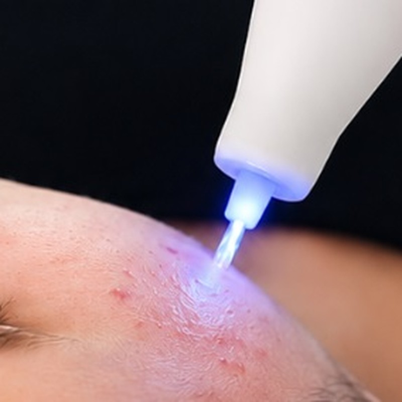 Głowica Plasma Jet w trakcie zabiegu